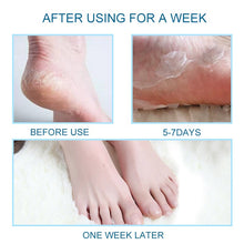 Load image into Gallery viewer, [Buy Toe Separator and Bunion corrector Online]-BetterToes