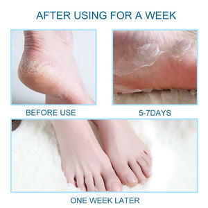 [Buy Toe Separator and Bunion corrector Online]-BetterToes